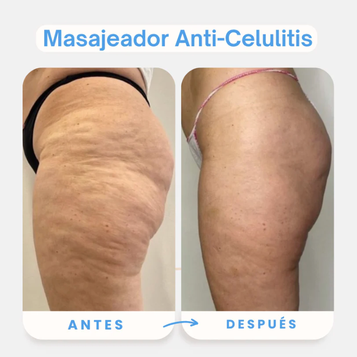 Masajeador Anti Celulitis